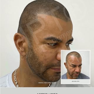 Using HPT®  #scalpmicropigmentation to restore  #hairline and add create the illusion of more consis