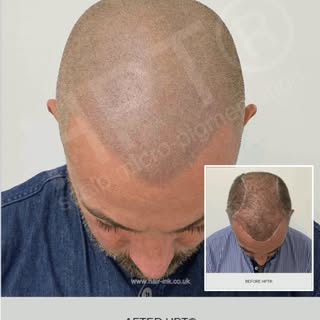 Best Natural Scalp Micropigmentation Results. HPT® scalp micropigmentation is the ultimate non-surgi