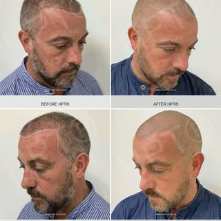 Hair Tattoo - Scalp Micropigmentation. One of the most important parts of the HPT® Scalp Micropigmen
