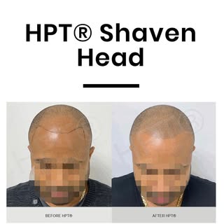 Shaven Head Result 🖊

For enquiries contact info@hair-ink.co.uk