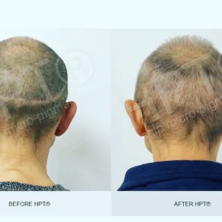 HPT FOR TRANSPLANT SCARRING 

HPT® scalp micro-pigmentation has been effectively used on a number of