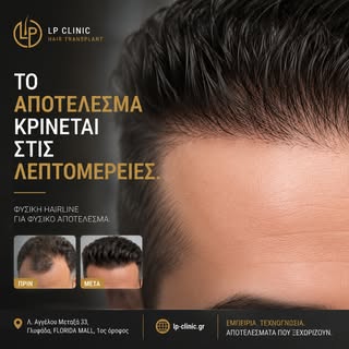 Η επιτυχία μιας μεταμόσχευσης μαλλιών δεν κρίνεται μόνο από την πυκνότητα.

Κρίνεται από τις λεπτομέ
