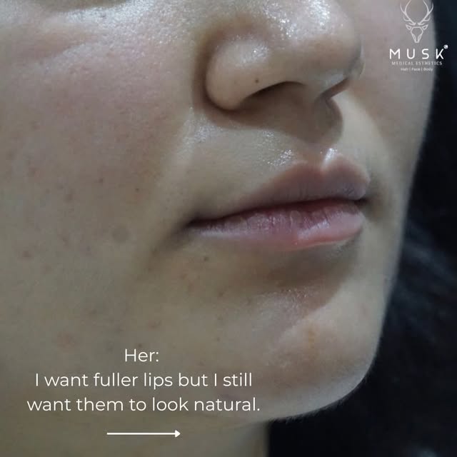Lips in 2026 are not bigger, they are better.

Everyone thinks lip filler is just about making lips 
