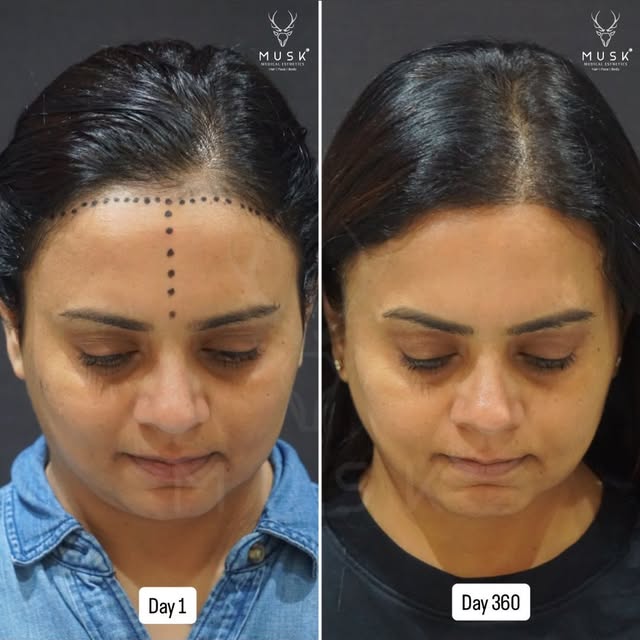 “I feel a sense of freedom now that I don’t have to constantly think about my hair anymore. I’m so r