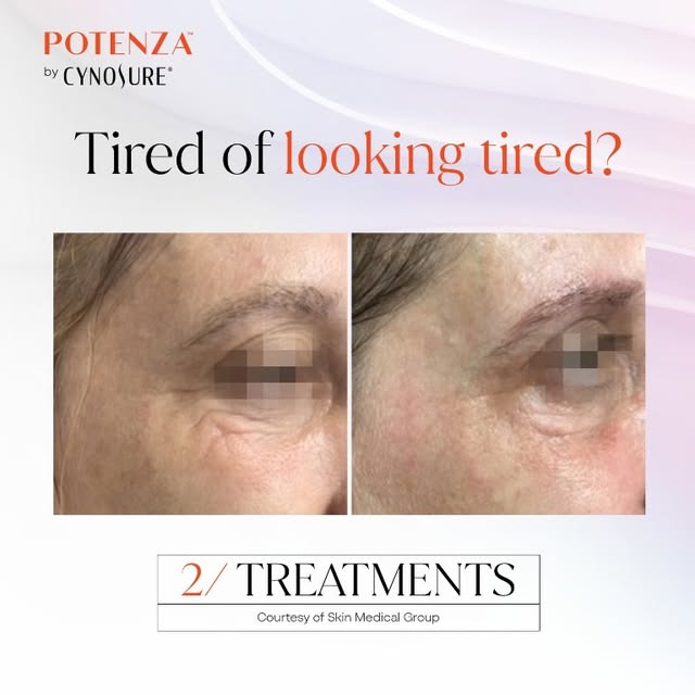 ✨ Tired of looking tired? It’s time for a refresh. ✨
For a limited time, you can treat the delicate 