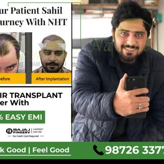 Our Patient Sahil Journey with NHT.

Results of our patient Sahil from Rampura.
He had opted for FUE