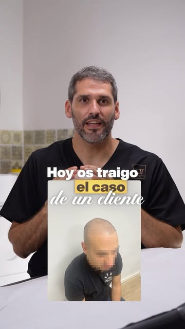 🧑🏻‍🦱 Se hizo un injerto hace dos años y seguía sin densidad en la zona frontal. Esto fue lo que h