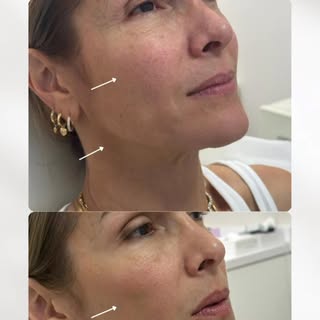 Toques mágicos @faby_colmenarez bellísima! 
📍 Amado Clinic | Doral, FL
✨ Agenda tu cita hoy y descu