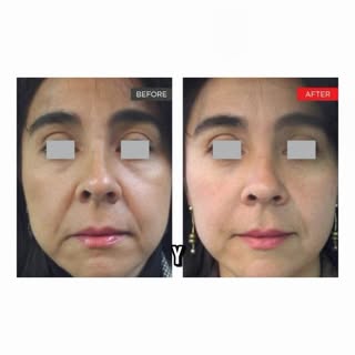 Láser Fotona:  para tratar diferentes necesidades:
✨ Rejuvenecimiento facial 4D
✨ Mejorar textura, l