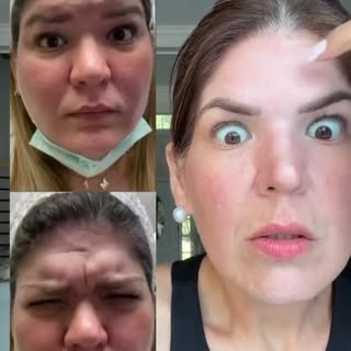El Botox no es magia de una sola cita… es un proceso. 💉
Con @ninaguimera hemos trabajado durante añ