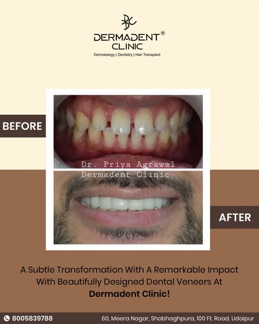 ✨ A smile transformation that speaks for itself! ✨

From unevenness to a beautifully designed, natur