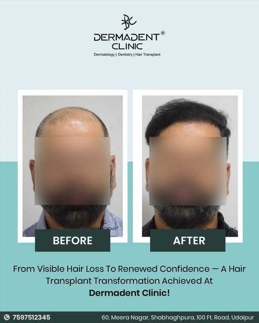 From visible hair loss to renewed confidence! ✨

A remarkable hair transplant transformation achieve