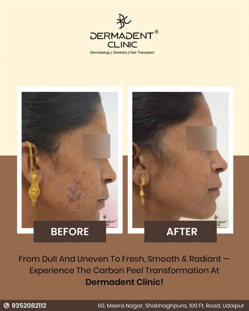 ✨ From dull & uneven to fresh, smooth & radiant! ✨

Witness the visible transformation with a Carbon