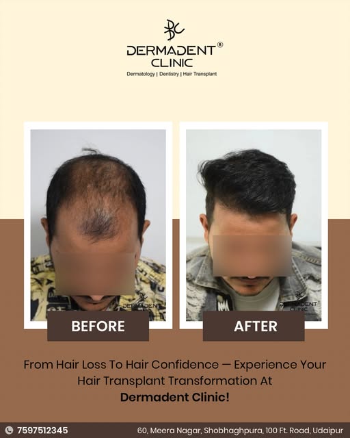 ✨ From Hair Loss to Hair Confidence! ✨

A fuller, natural-looking hairline can make a powerful diffe