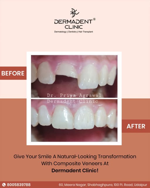 Transform your smile with a natural-looking finish using Composite Veneers at Dermadent Clinic.

For
