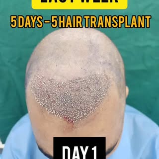 Hair Line Reebot
Get your confidence BACK!!!

#HairTransplantIndia #MaxillofacialSurgeon 
#FueIndia 