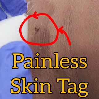 One small change, BIG confidence boost 💫

This painless skin tag removal was done right in the OPD 