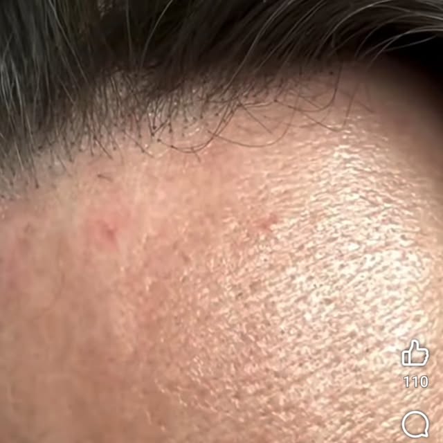 How invisible is a hair system?  Well, this is what your hairline would look like.  Nobody is gonna 