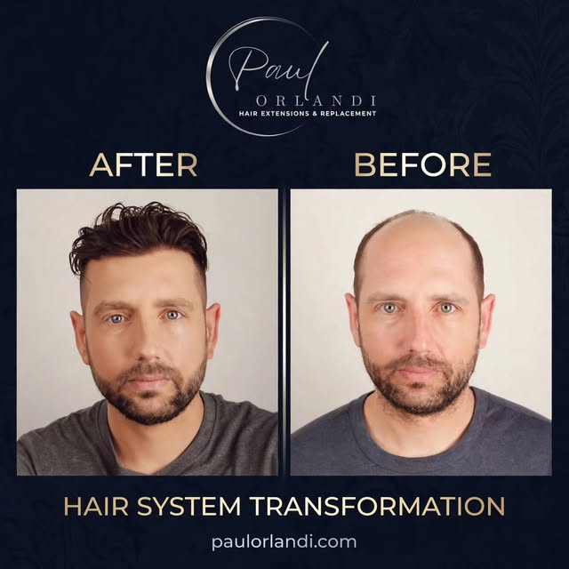 Hair System Transformation ✨

Discreet. Natural. Undetectable.

This custom hair system restored not