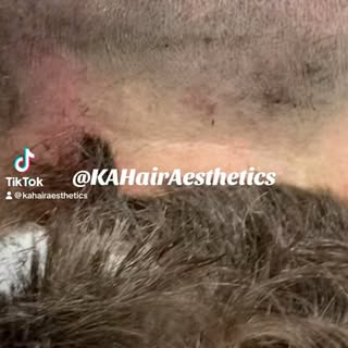 Happy Tuesday!!! 😎 #kahairaesthetics #hairloss #neograft #hairrestorationsurgery #prp #fue