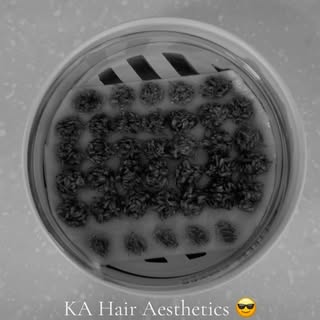 Another day @KAHairAesthetics 😎 #hairtransformation #hairtransplant #neograft #fue #prp #atlantahai