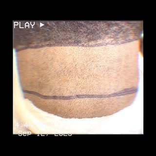 Happy Tuesday yall!!! It’s never too late to get your hairline back🤗 #hairtransformation #hairtrans