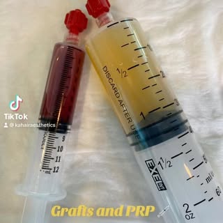 Grafts + PRP = WINNING 🏆 #hairtransformation #hairtransplant #KAHairAesthetics #prp #grafts #Neogra