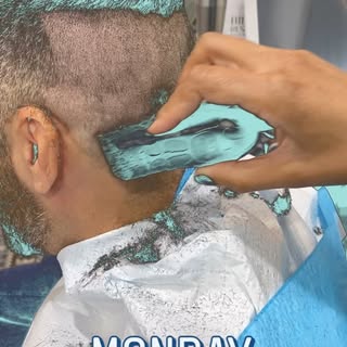 Happy Monday💉 #KAHairAesthetics #hairtransformation #hairtransplant #prp #fue #hairlinesareimportan