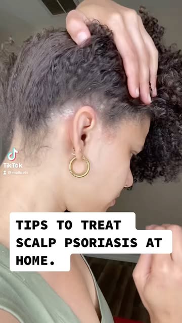 Made this video less than a month ago and the psoriasis on the scalp has cleared 100%. 

The vibrati