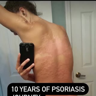 TREAT THE CAUSE, NOT THE SYMPTOM.

10 years. 10 years since I had my first psoriasis flare up. 10 ye