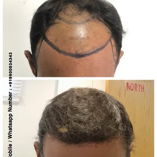 6 months post hair transplant 
Natural looking results 
Happy clients 

- REVIERRA

(World Class Hai
