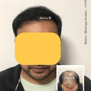 6 months post HT

- REVIERRA

(World Class Hair Care & Hair Transplants). 

India - Italy - Russia -