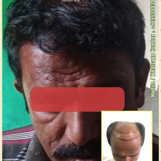 3000 grafts - 1 session
iBioFue Ⓡ technique 

#hairtransplant 
#HairTransplantBeforeAfter
#ivaGlobal