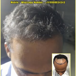 #HairTransplant Before & After
#iBioFue Ⓡ 

- REVIERRA

(World Class Hair Care & Hair Transplants). 