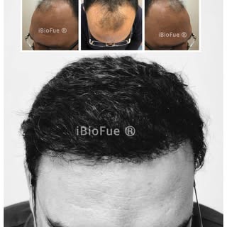 #hairtransplant 
#beforeafter 
#ibiofue 

- REVIERRA

(World Class Hair Care & Hair Transplants). 

