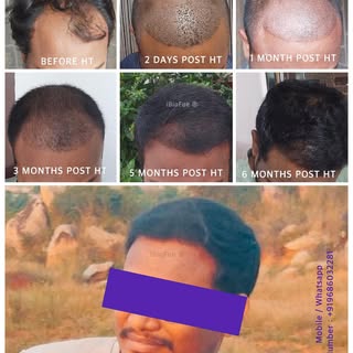 Natural looking hairline design
Monthly progress 
Before and After Hair Transplant

 

- REVIERRA

(