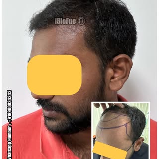 Just 5 months post hair transplant 
It would improve much more in next 2-3 months 

- REVIERRA

(Wor