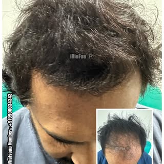 8 months post HT 

- REVIERRA

(World Class Hair Care & Hair Transplants). 

India - Italy - Russia 
