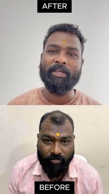 5 Months After Hair Transplant | Genuine Patient Review ❤️

“Honestly, I’m really happy with my resu