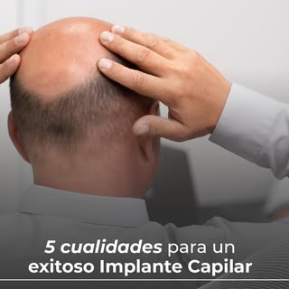 🧬🏆 5 CLAVES DE UN IMPLANTE CAPILAR EXITOSO

El Dr. Pedro Cremona te lo explica en este reel.

🎥 M