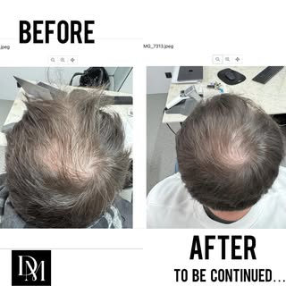 Before/After 
Toujours en cours de traitement, ça promet 🚀 

- Résultat individuel présenté avec co