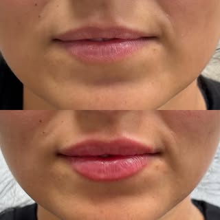 Lips of the day 👄 
Patient dépendant