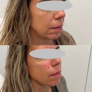 Amélioration de la vallée des larmes, de l’oval du visage et des sillons avec seulement 1ml 💉 #avec