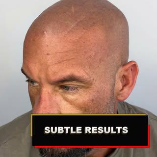 Hair loss treatment completed for my client. Subtle, natural, and looking sharp. 💯 #SMP #ScalpMicro
