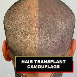My client had a successful hair transplant and achieved the hair growth he was hoping for. However, 