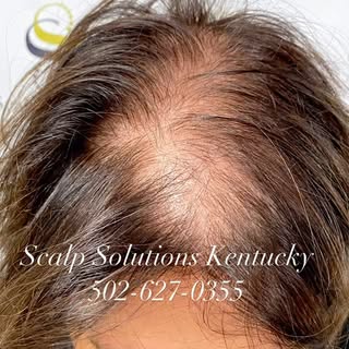 Shouldn’t You Feel Good Too? Don’t let hair loss rule your life. Let scalp solutions Kentucky boost 
