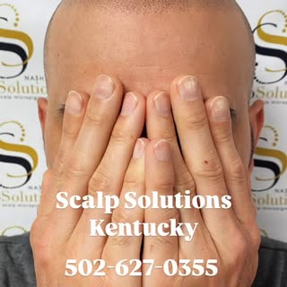 This Could Be Your Most Confident Summer Yet! Scalp Micropigmentation (SMP) could be the answer to f