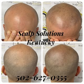 Hairloss Isn’t Going To Go Away On It’s Own. Let Scalp Solutions Kentucky make your journey back to 