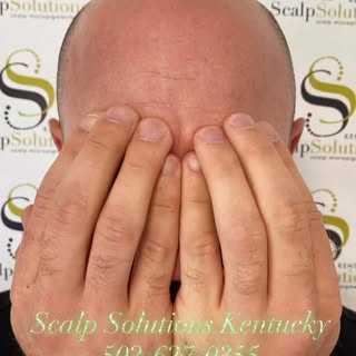Didn’t Get What You Wanted For Christmas? It’s NOT To Late. Call Scalp Solutions Kentucky today. You