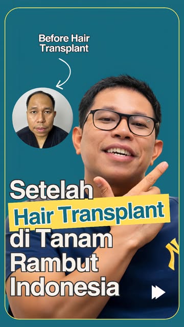 Dulu sempat merasa kurang percaya diri karena rambut mulai menipis.
Sekarang? Pak Tomy Andreas justr